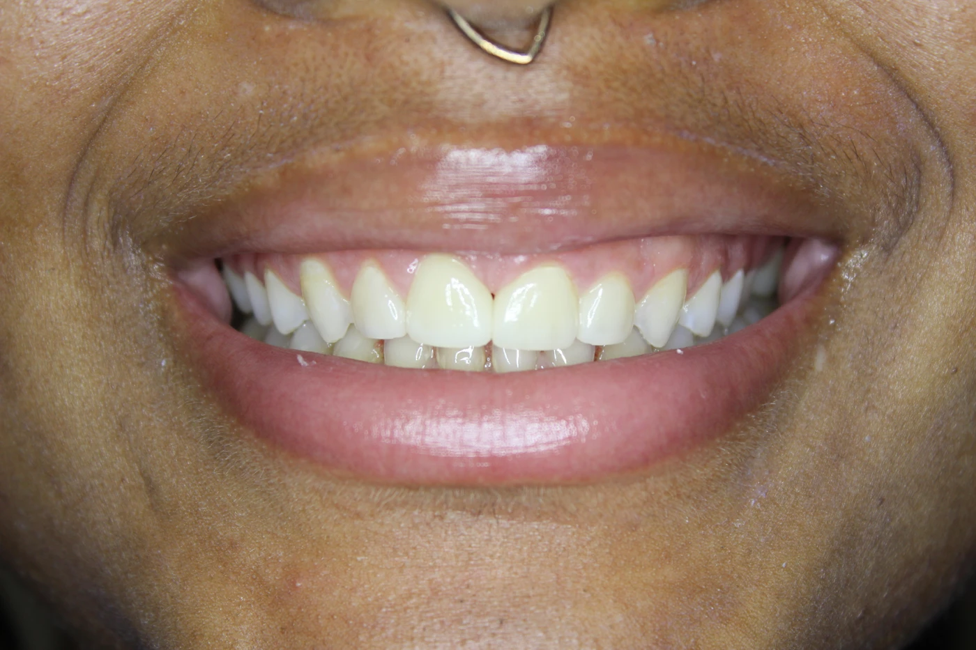 Smile 4, after — close-up